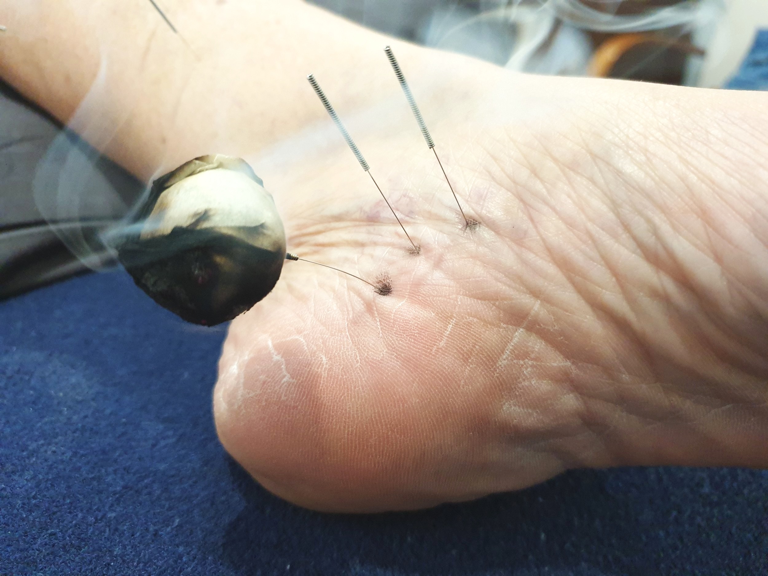 Chinese herbs clearance for plantar fasciitis